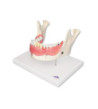 Model - Zubní onemocnění