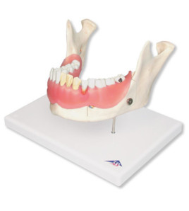 Model - Zubní onemocnění