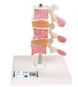 Model osteoporózy – 3 obratle v řezu