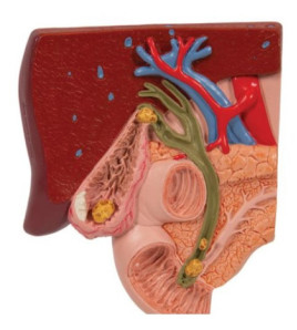 Model žlučového kamene