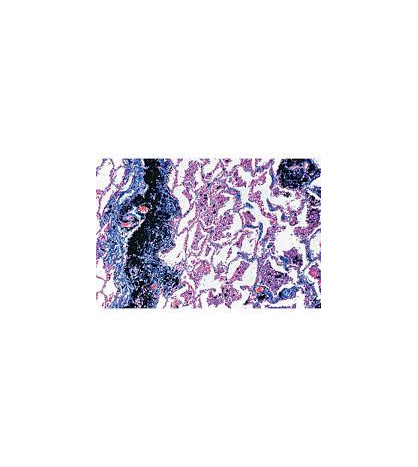 Preparáty - 1× zdravá arterie, 1× arteroskleróza